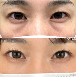 寺西宏王 大阪 梅田大阪駅前 院長 クマ取り症例 切らない目の下のクマ取り・目の下のたるみ（ふくらみ）取り 【切らない目の下のクマ取り・目の下のたるみ（ふくらみ）取りの施術概要】下まぶたの裏側を1cmほど切開し、余分な脂肪を取り除く施術です。目の下のふくらみが目立つ、疲れて見える、クマのように見えるという状態を解消します。 【切らない目の下のクマ取り・目の下のたるみ（ふくらみ）取りのリスク】まぶたの裏側を切開するので傷跡は外からはわかりません。腫れは数日～1週間でほぼ落ち着きますが、より自然な仕上がりとなるまでに1ヶ月ほど要します。 【クマ取り再生注射の施術概要】1回の注射で脂肪溶解、再生因子、注入治療成分を注入し、目の下のクマを改善します。 【クマ取り再生注射のリスク】腫れ・痛み・内出血：2日程度