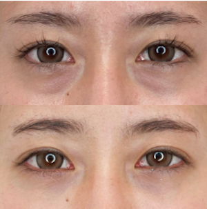 富田秀鷹 新宿三丁目院 院長 クマ取り症例 切らない目の下のクマ取り・目の下のたるみ（ふくらみ）取り 【切らない目の下のクマ取り・目の下のたるみ（ふくらみ）取りの施術概要】下まぶたの裏側を1cmほど切開し、余分な脂肪を取り除く施術です。目の下のふくらみが目立つ、疲れて見える、クマのように見えるという状態を解消します。 【切らない目の下のクマ取り・目の下のたるみ（ふくらみ）取りのリスク】まぶたの裏側を切開するので傷跡は外からはわかりません。腫れは数日～1週間でほぼ落ち着きますが、より自然な仕上がりとなるまでに1ヶ月ほど要します。 【クマ取り再生注射の施術概要】1回の注射で脂肪溶解、再生因子、注入治療成分を注入し、目の下のクマを改善します。 【クマ取り再生注射のリスク】腫れ・痛み・内出血：2日程度