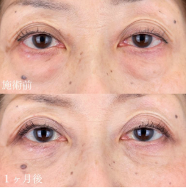 山本展生 名古屋栄院 院長 クマ取り症例 切らない目の下のクマ取り・目の下のたるみ（ふくらみ）取り 【切らない目の下のクマ取り・目の下のたるみ（ふくらみ）取りの施術概要】下まぶたの裏側を1cmほど切開し、余分な脂肪を取り除く施術です。目の下のふくらみが目立つ、疲れて見える、クマのように見えるという状態を解消します。 【切らない目の下のクマ取り・目の下のたるみ（ふくらみ）取りのリスク】まぶたの裏側を切開するので傷跡は外からはわかりません。腫れは数日～1週間でほぼ落ち着きますが、より自然な仕上がりとなるまでに1ヶ月ほど要します。 【クマ取り再生注射の施術概要】1回の注射で脂肪溶解、再生因子、注入治療成分を注入し、目の下のクマを改善します。 【クマ取り再生注射のリスク】腫れ・痛み・内出血：2日程度