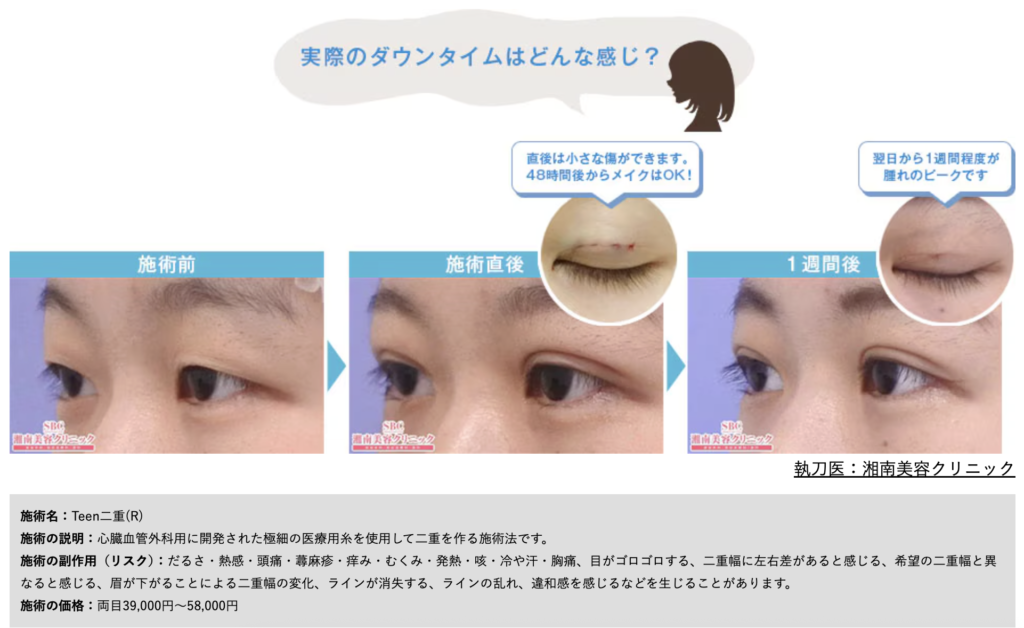 SBC湘南美容クリニック Teen二重®の術後からの経過画像