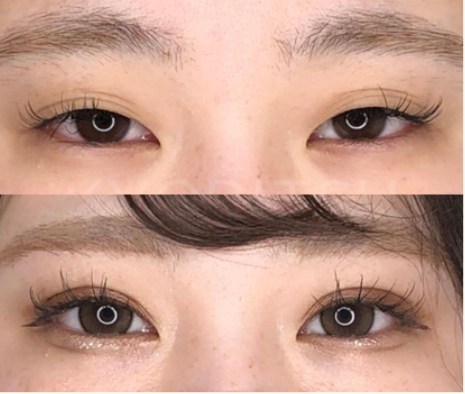 共立美容外科の二重の症例