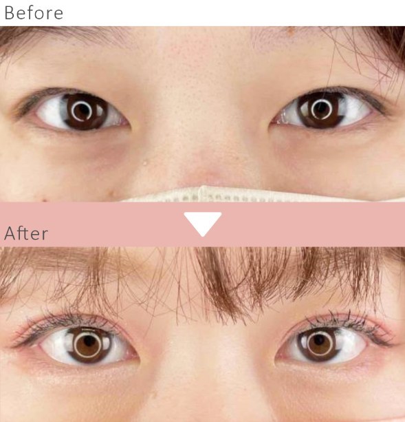 ルラ美容クリニックの二重整形の症例