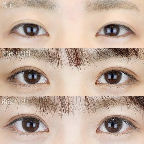 TCB東京中央美容外科の「TCB二重術」ビフォーアフター