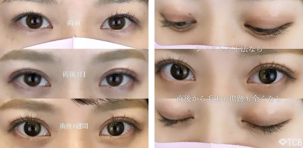 埋没法＋目頭切開