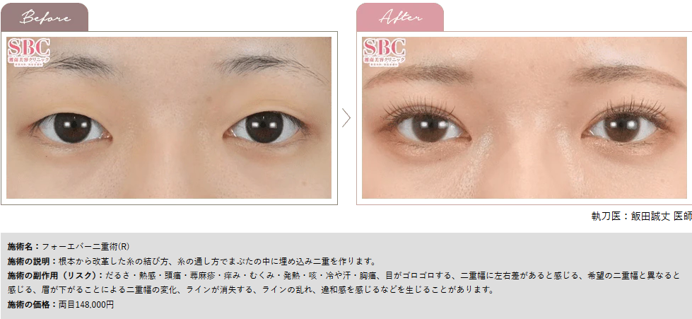 フォーエバー二重術®