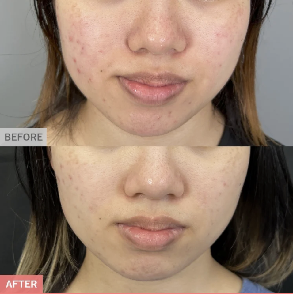 TCBピコフラクショナルの症例画像