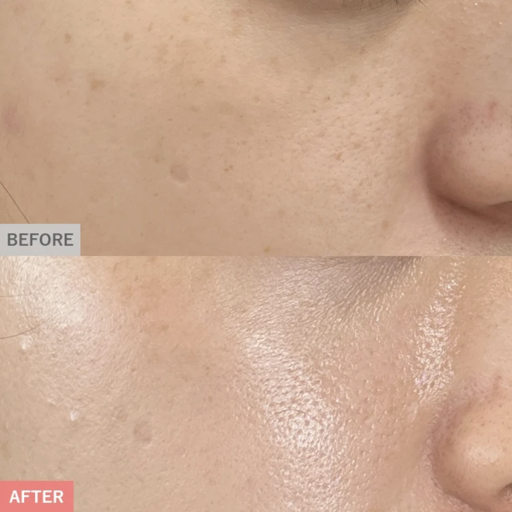 TCBピコスポットの症例画像