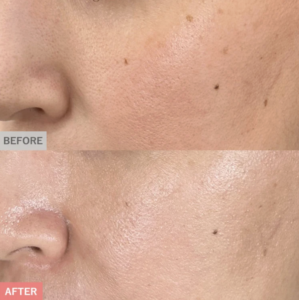 TCBピコトーニングの症例画像