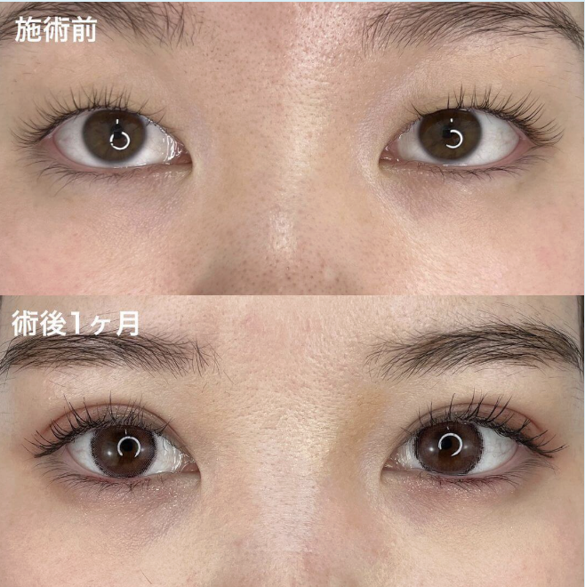 TCB東京中央美容外科の二重術の症例画像