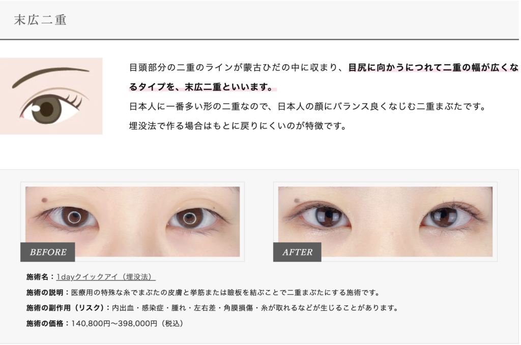 TCBの末広二重画像