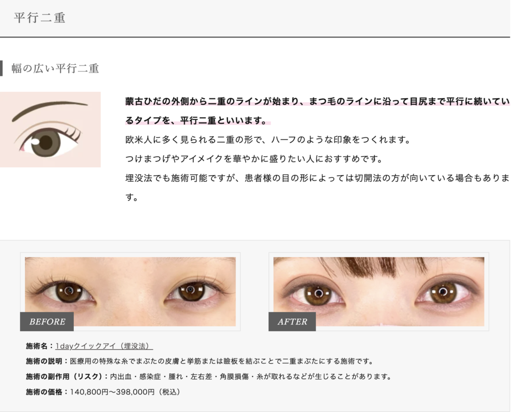 TCBの平行二重画像