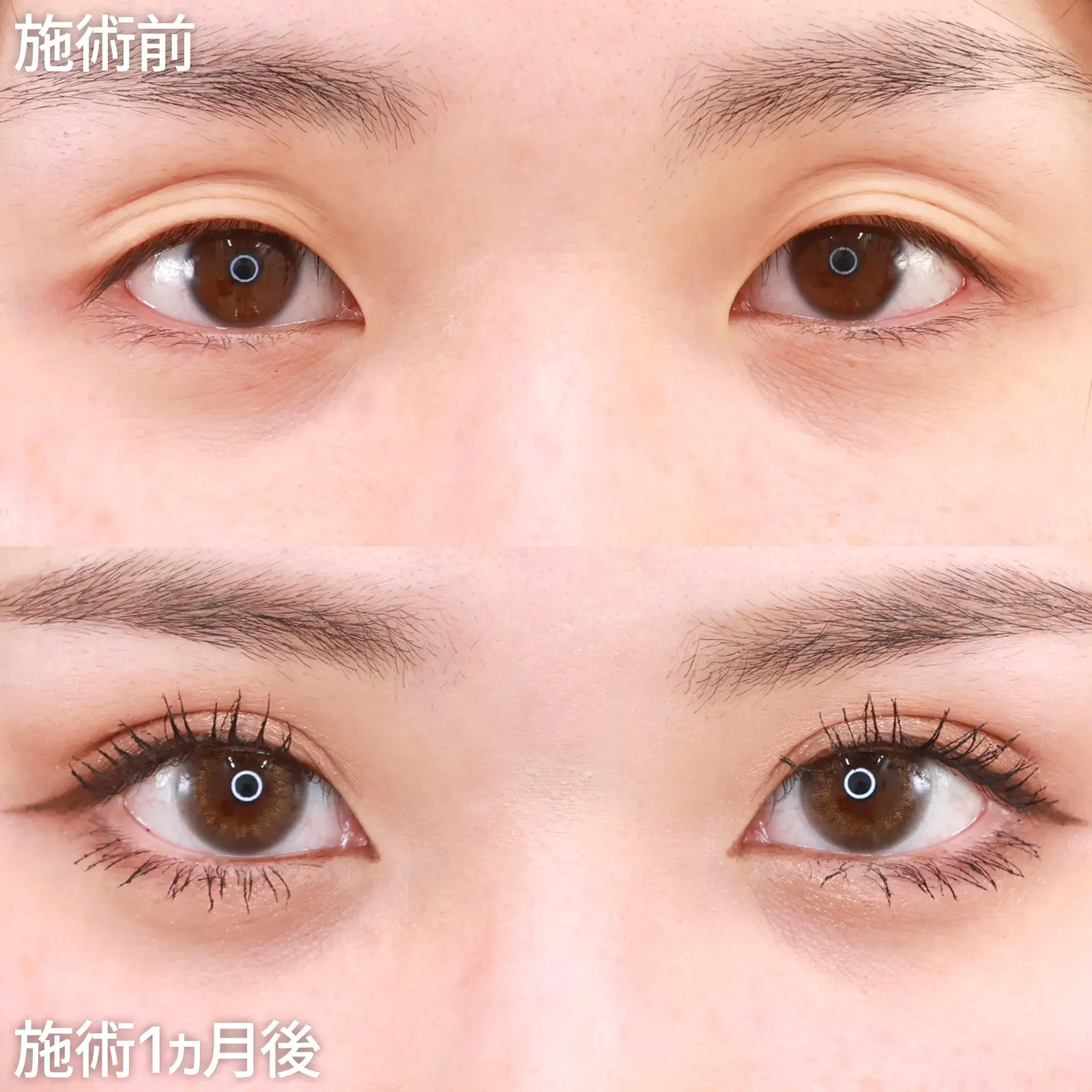 TAクリニック 二重整形 症例