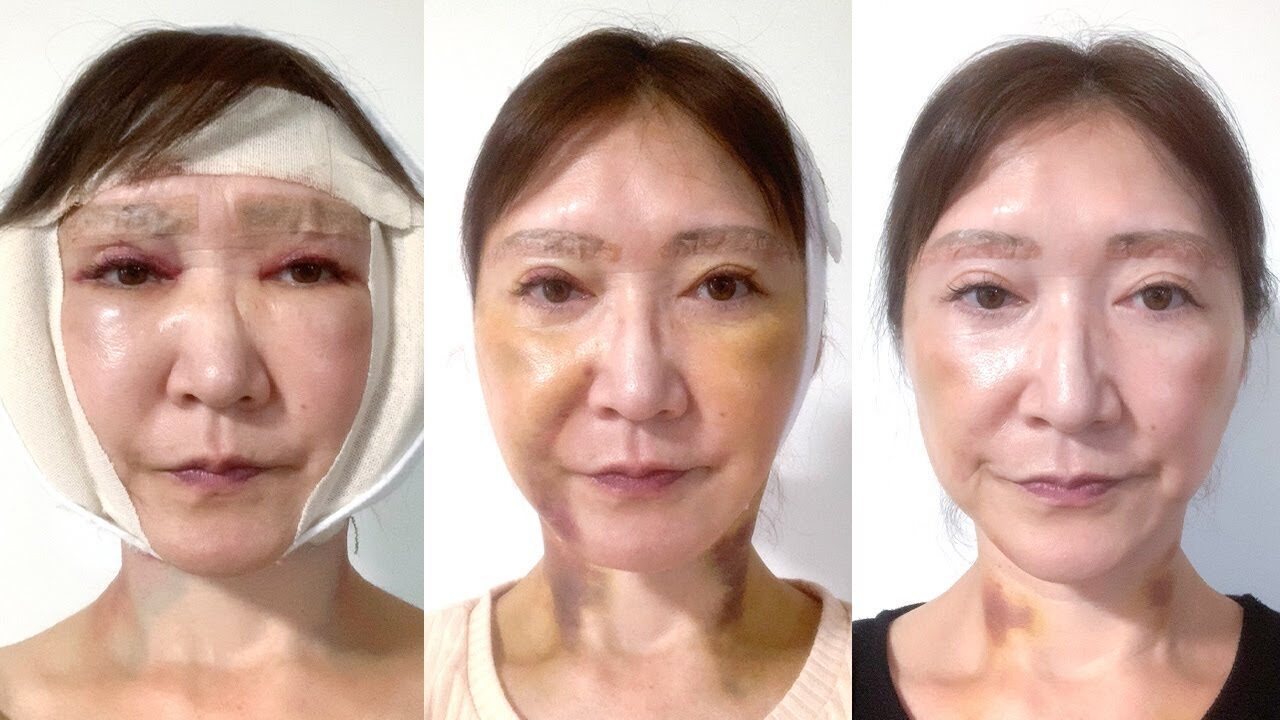 【フェイスリフト＆眉下リフト】1ヶ月間のダウンタイム毎日密着