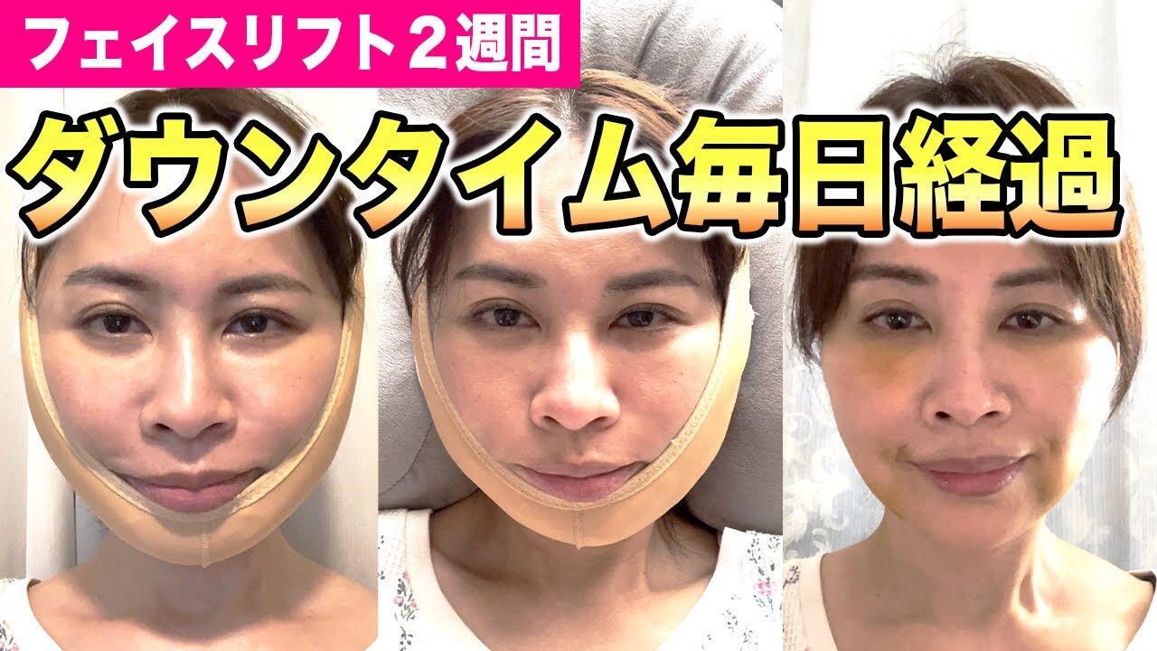 【フェイスリフト】ダウンタイムが気になる方はご覧下さい✨翌日〜2週間の経過をお届け💡