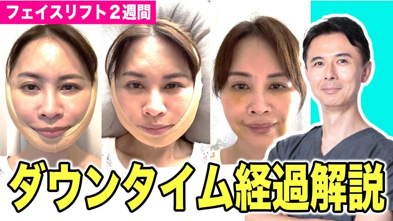 フェイスリフトのダウンタイムはどれくらい？翌日〜2週間の経過と腫れ・内出血のリアル