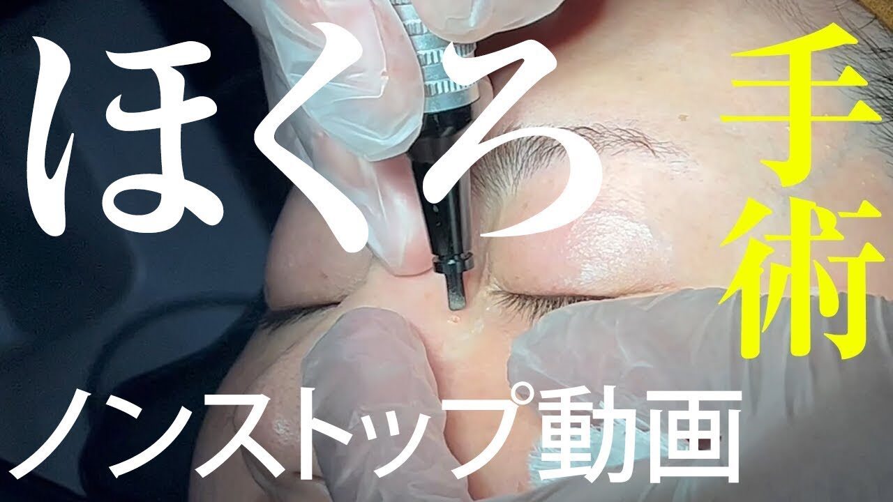 ほくろレーザー手術、全て見せます。【手術動画】