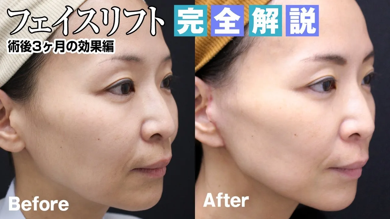 【院長のフェイスリフト解説】術後3ヶ月でどのくらい引き上がる？