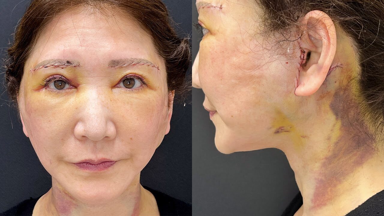 【フェイスリフト&眉下リフト】手術3日後のダウンタイム【週末うめこコラボ企画】