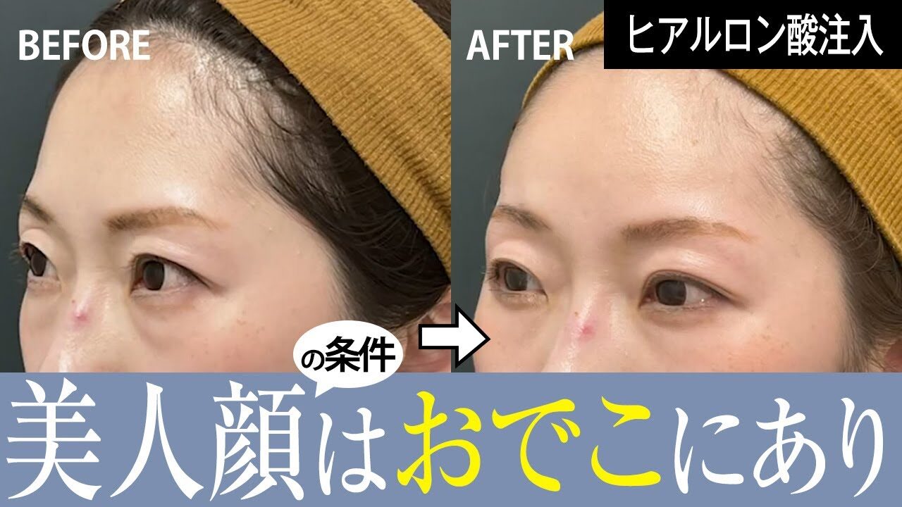 【注入治療 額】丸みをもたせる若見え！額注入治療に密着