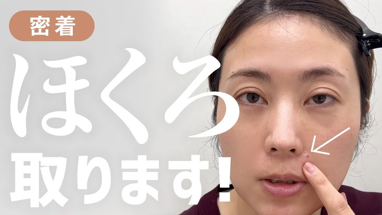 ほくろ除去は1個1分！長年のコンプレックスが一瞬で解消【手術動画あり】