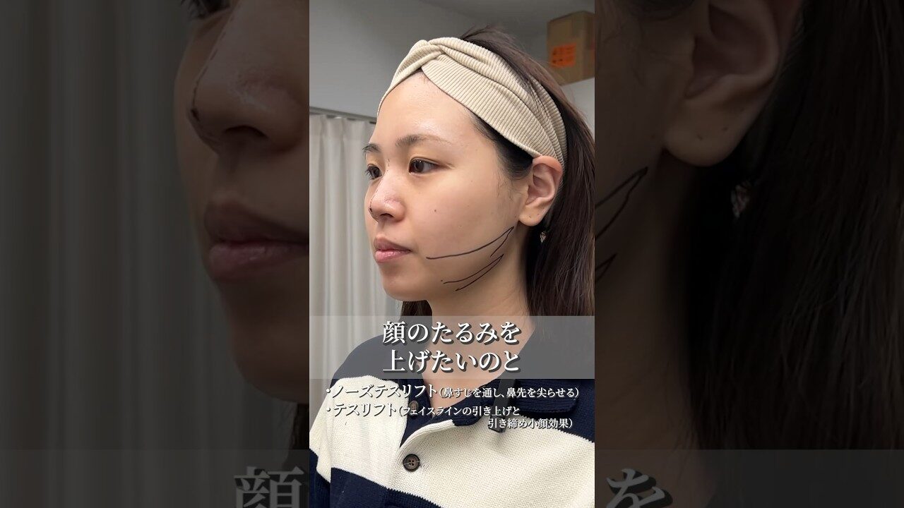 【鼻の糸リフト】鼻を高くするノーズテスリフト