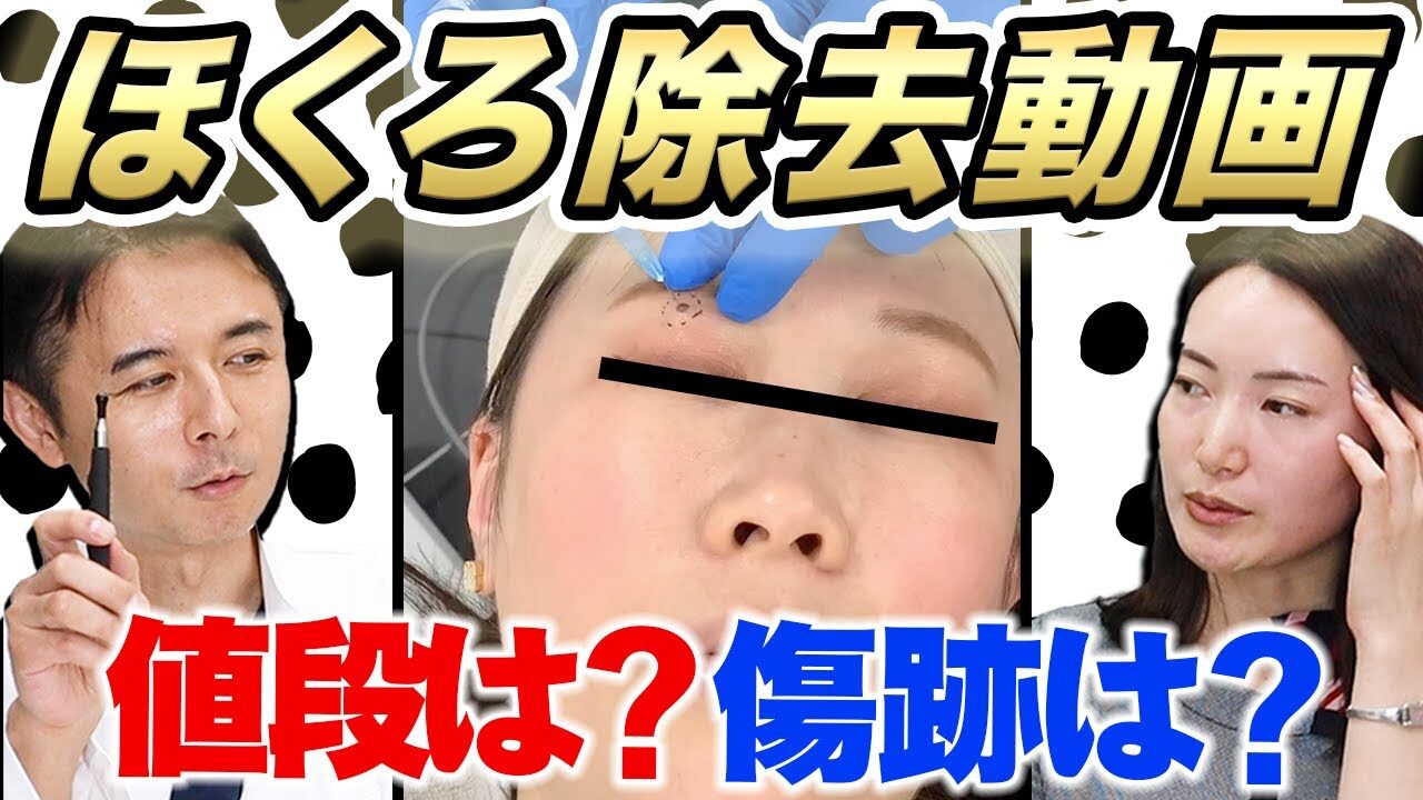 【ほくろ除去】実際の手術動画を見ながら解説！「安く・綺麗に」ほくろを取るには？