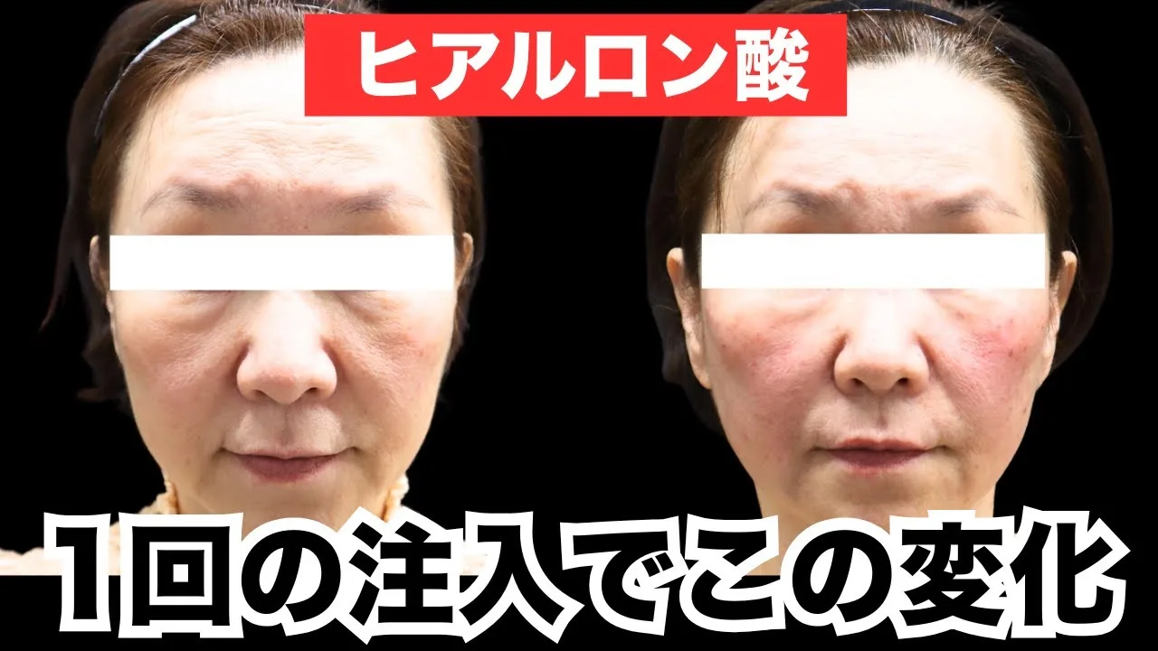 1回の注入でここまで変わる❗️ヒアルロン酸リフトの実力✨【#ヒアルロン酸】