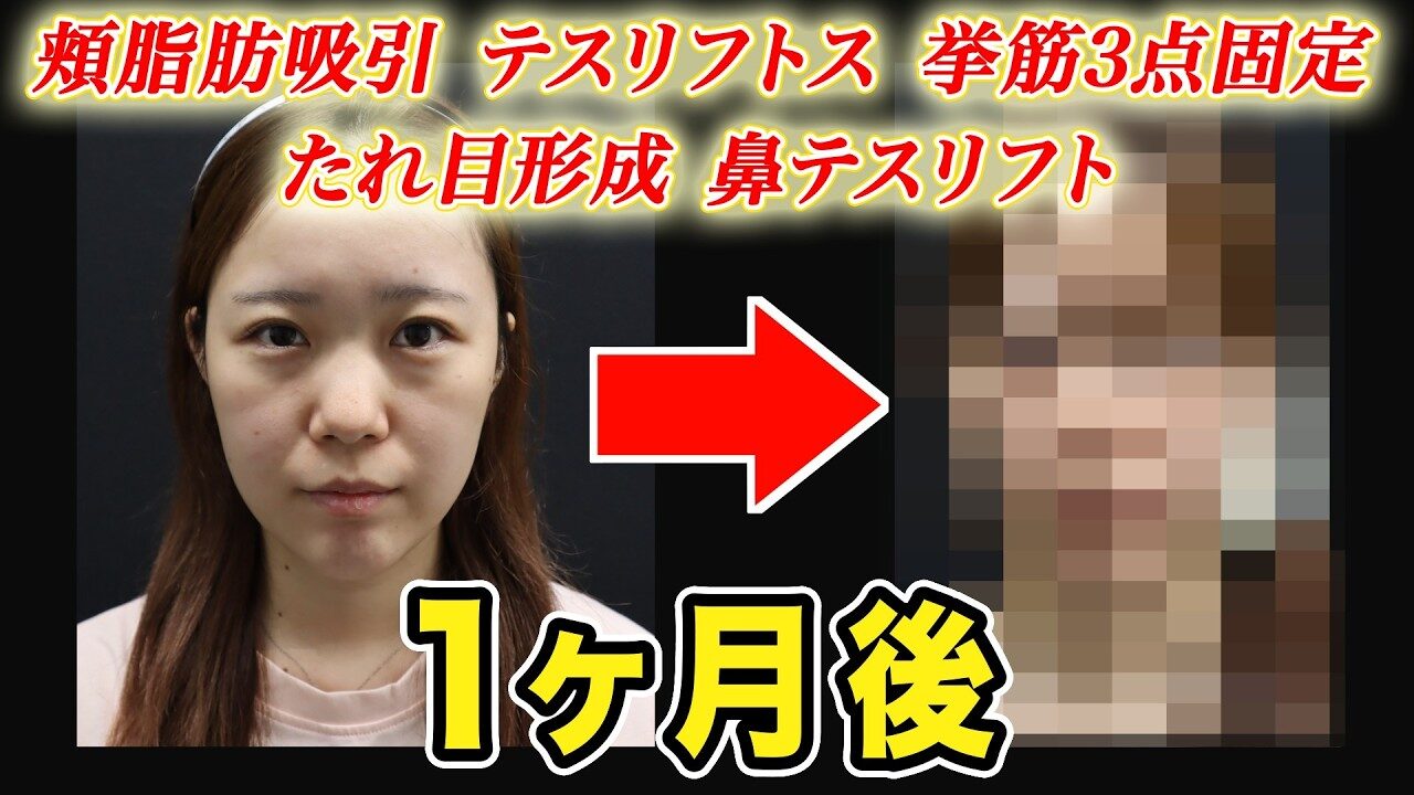 顔の複合施術から1か月後｜自然な変化と残る硬さ・違和感を症例で解説