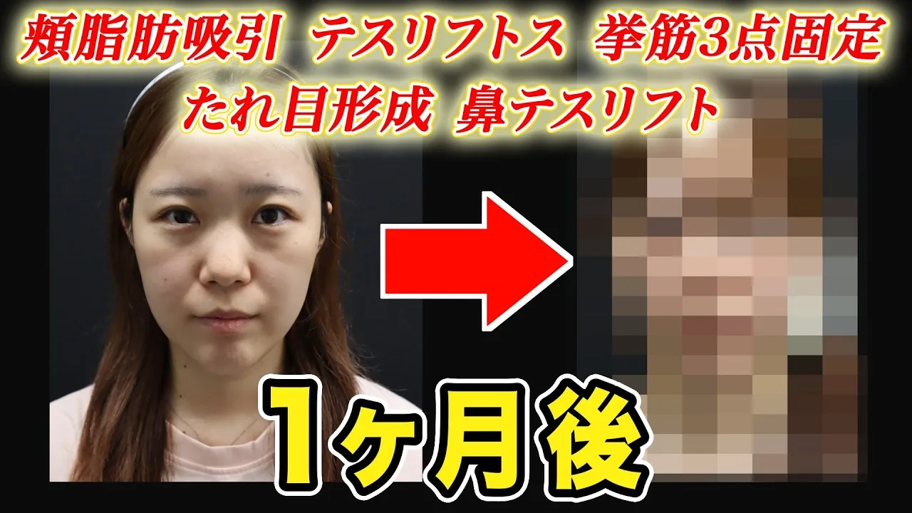 顔の複合施術から1か月後｜自然な変化と残る硬さ・違和感を症例で解説