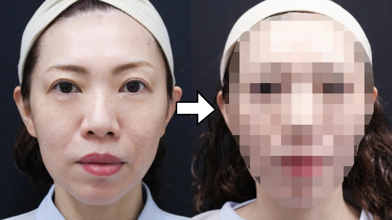 【フェイスリフト】「輪郭ピンッ！あごもシャープになった！」手術から6ヶ月後の経過