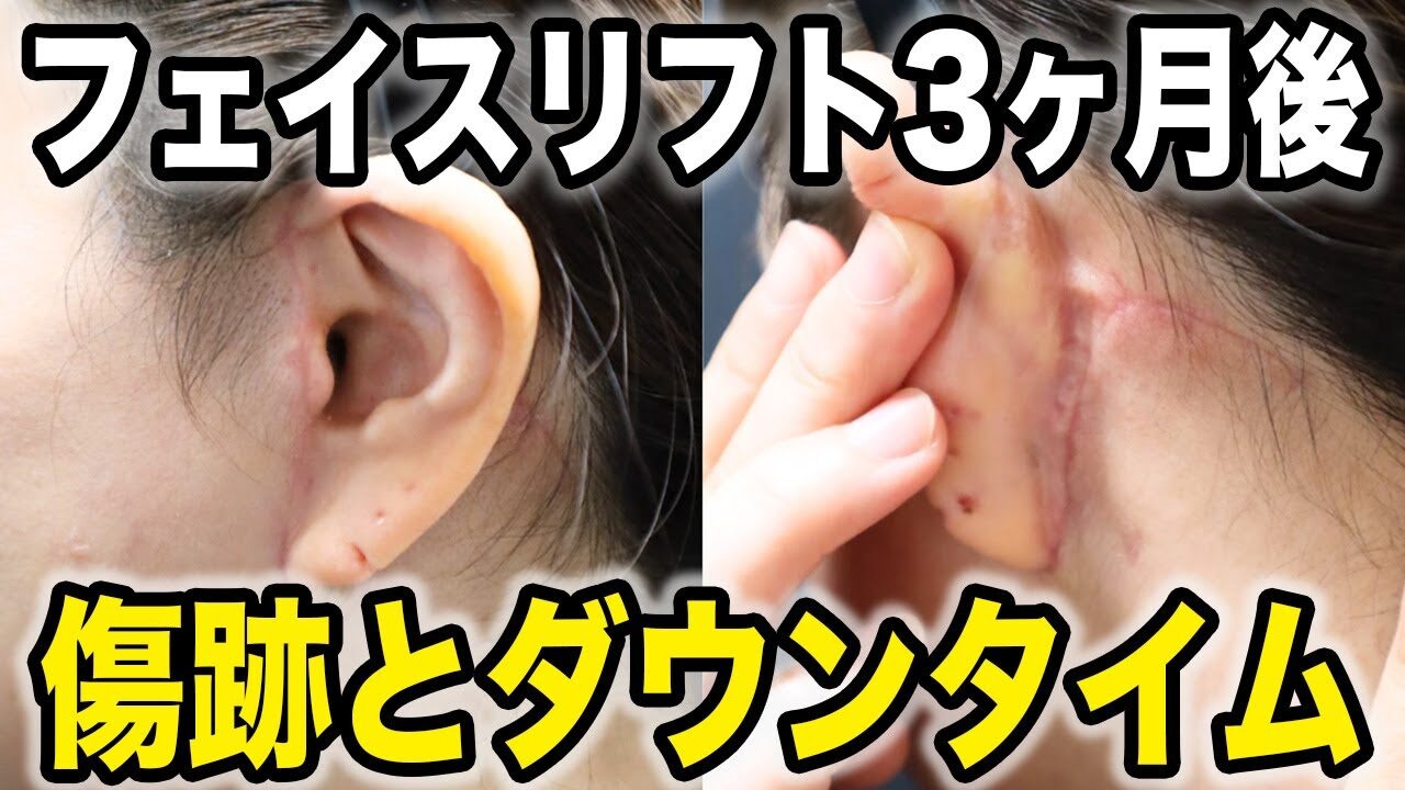 フェイスリフト3ヶ月後の傷跡公開✨やって後悔した事は❗️❓