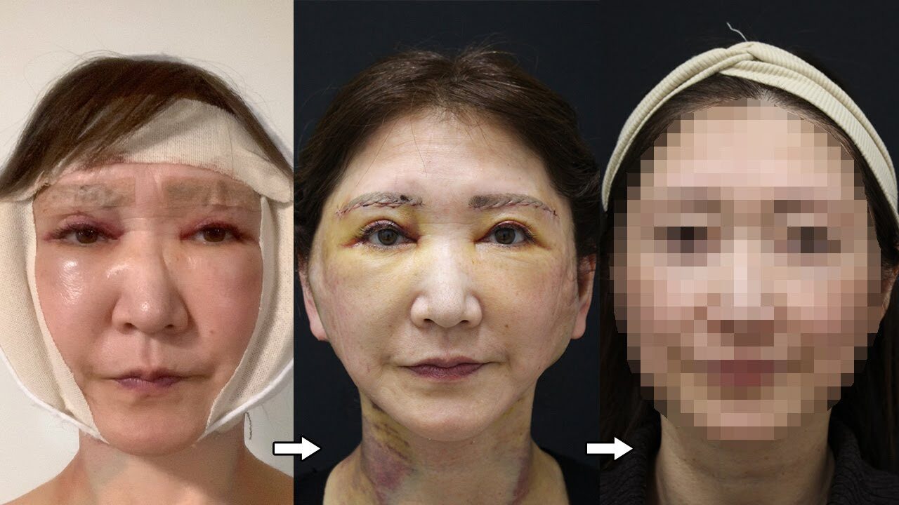 【フェイスリフト＆眉下リフト】3ヶ月間のダウンタイム報告【週末うめこコラボ】