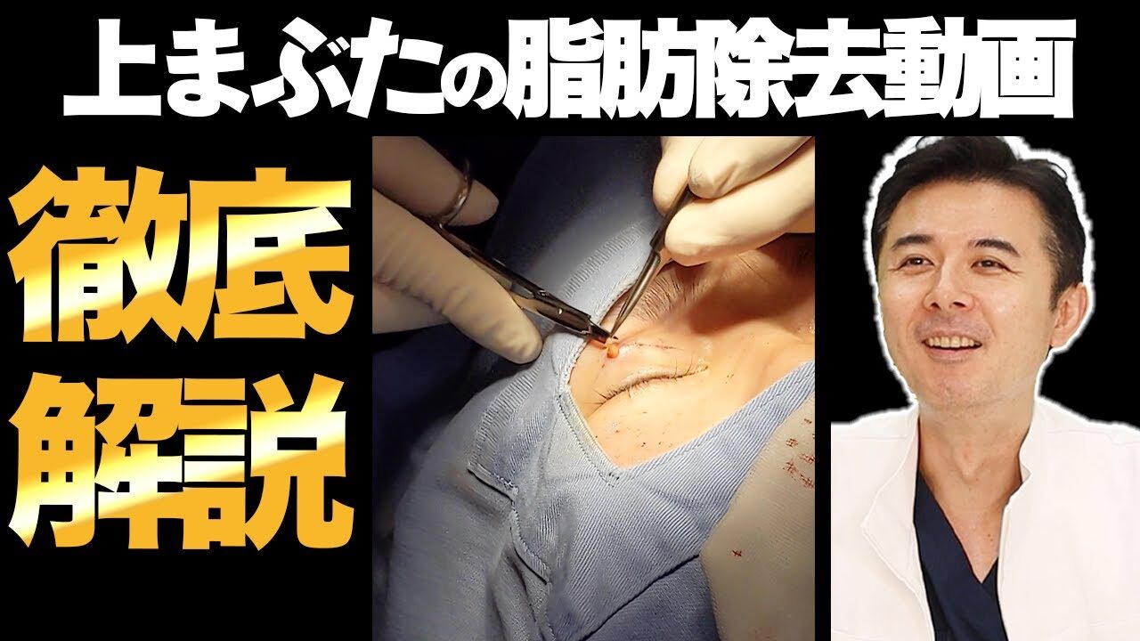 【上まぶたの脂肪取り】二重ラインがはっきり！？実際の映像を交えて専門医が徹底解説します！